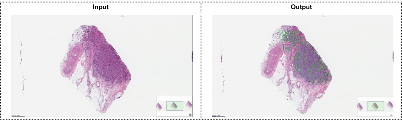 Özet P55: Automated Invasive Area Detection in Breast Cancer